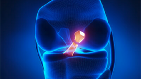 Diagram of ACL Injury