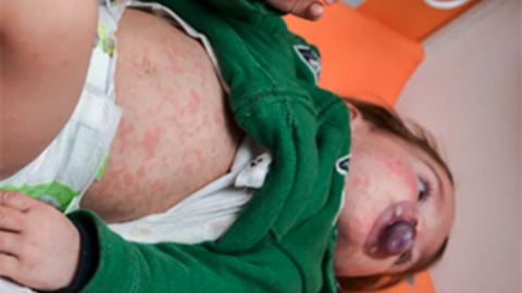Child with measles infection.